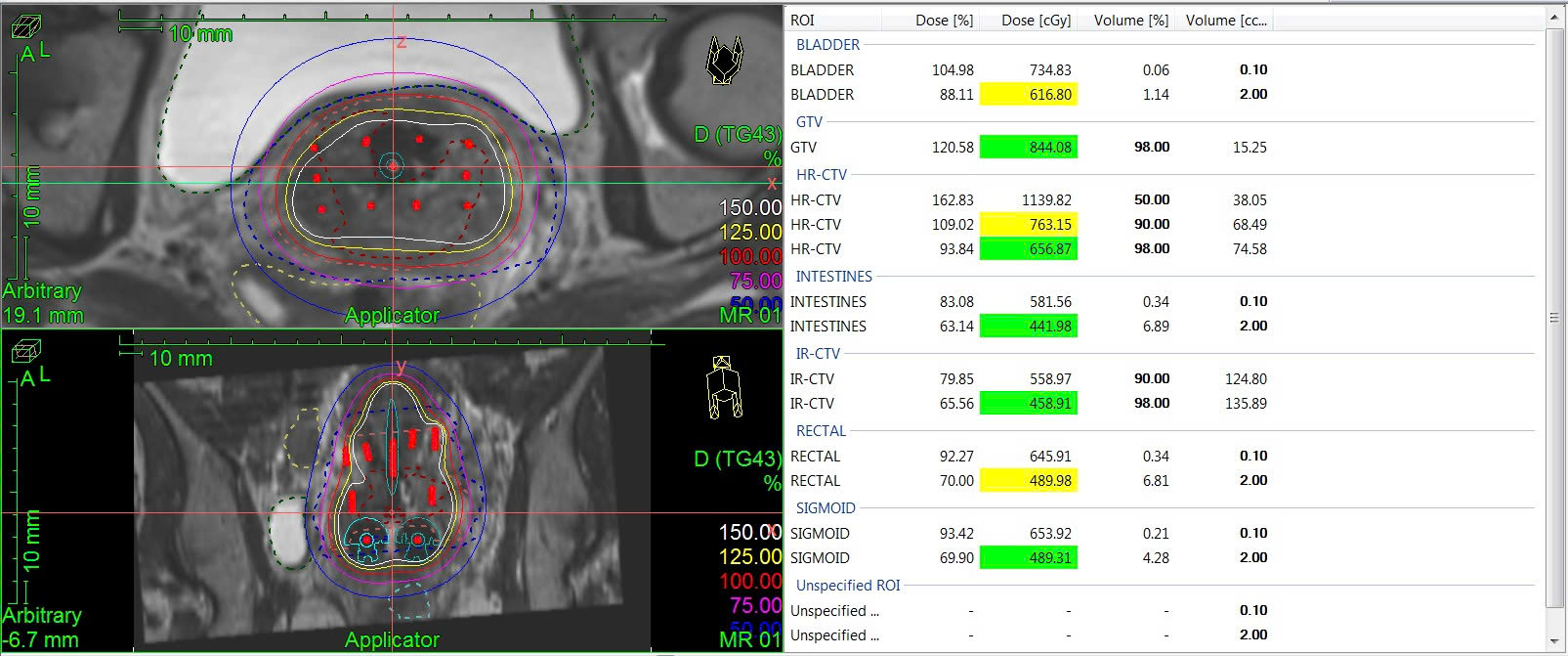 Hình minh họa phân bố liều trong xạ trị áp sát (brachytherapy)